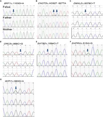 Whole-Exome Sequencing Identifies Damaging de novo Variants in Anencephalic Cases